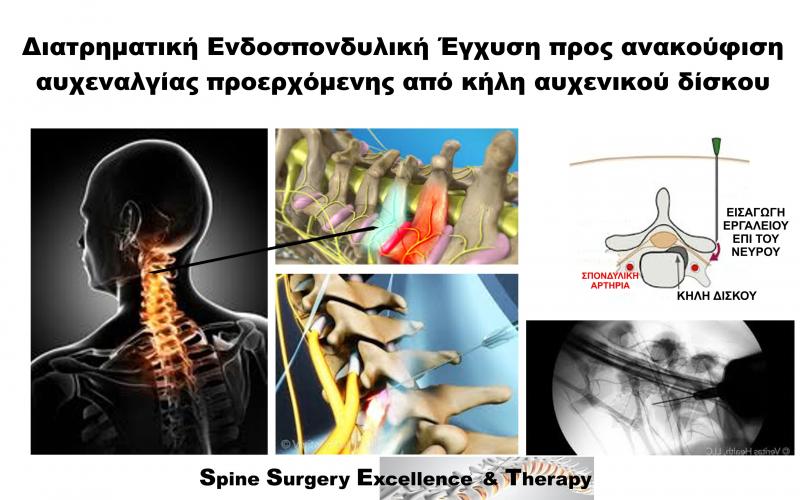 Διατρηματική Ενδοσπονδυλική Έγχυση