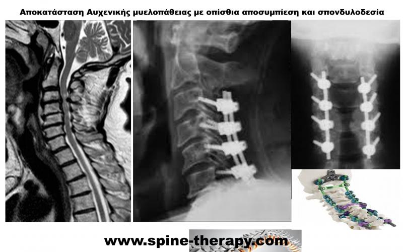 Cervical Myelopathy
