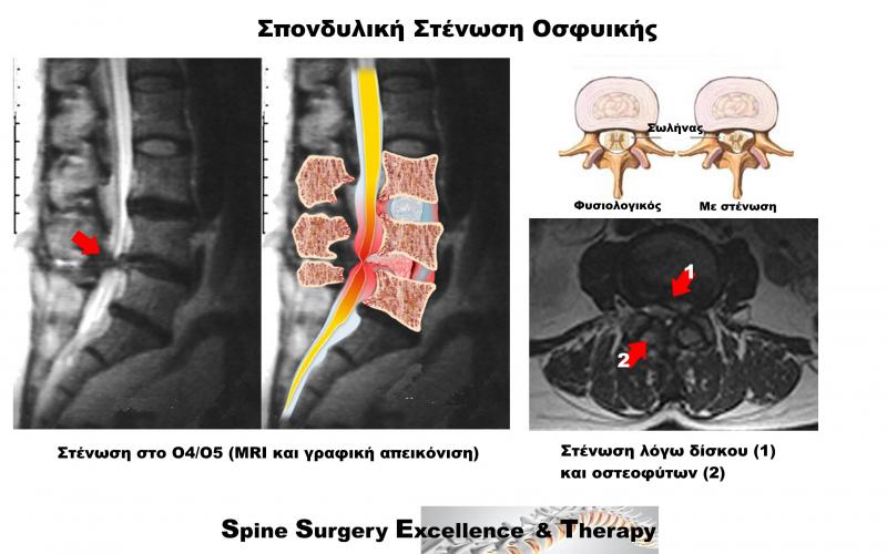 Spinal Stenosis